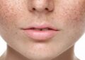 Biểu hiện của làn da bị vấn đề nám nắng