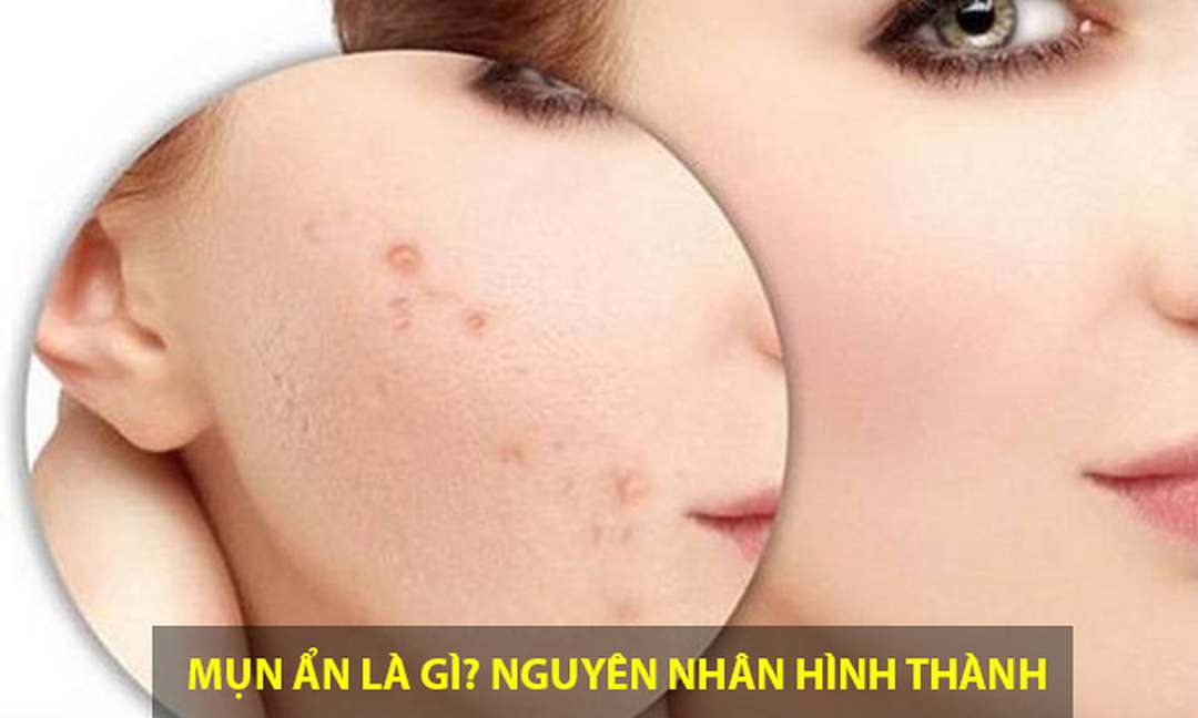 Tìm hiểu cách trị mụn ẩn phải biết được nguyên nhân