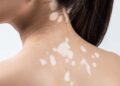 Dấu hiệu nhận biết lang ben ở lưng