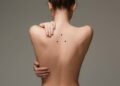 Nốt ruồi sau lưng nữ và nam có ý nghĩa gì? Có nên tẩy đi không?