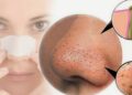 13 Sản Phẩm Trị Mụn Đầu Đen Tốt Nhất