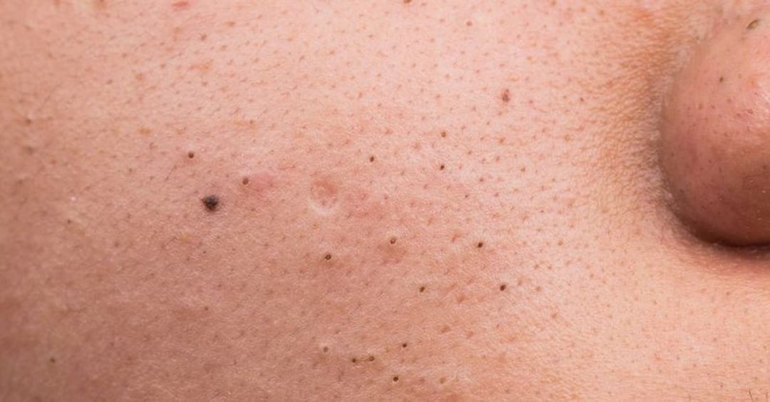 Mụn đầu đen thường xuất hiện do dầu thừa tích tụ trên da