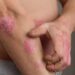 Bệnh vảy nến có chữa trị được không?