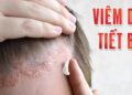 Nguyên nhân gây bệnh viêm da tiết bã nhờn