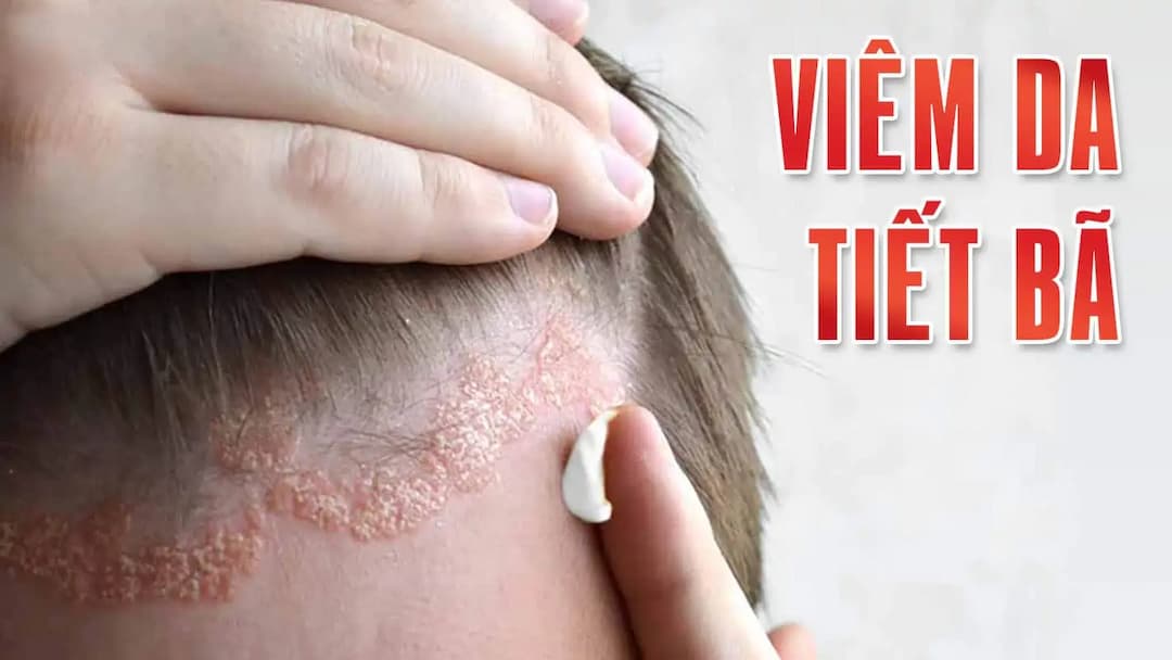 Nguyên nhân gây bệnh viêm da tiết bã nhờn