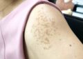 Cách xóa bỏ đồi mồi và tàn nhang