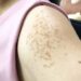 Cách xóa bỏ đồi mồi và tàn nhang