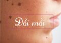 Cách trị đồi mồi bằng dưa chuột