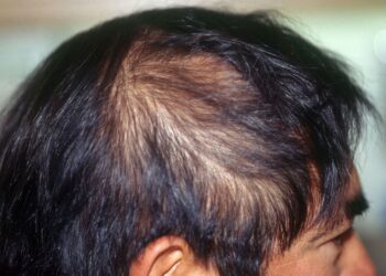 Tác dụng của tỏi đối với mái tóc bạn nên biết