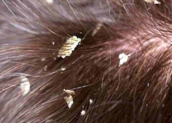 Tình trạng gàu ngứa đáng lo ngại 