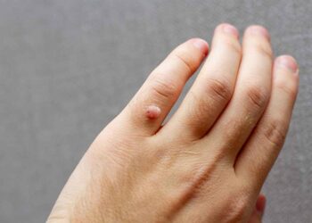 Kiến thức chung về mụn cóc