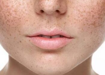 Biểu hiện của làn da bị vấn đề nám nắng