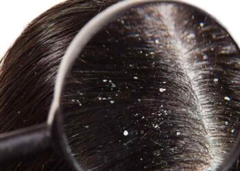 Những mảng gàu trên tóc