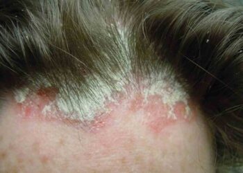 Khái niệm và tất thảy thông tin về nấm đầu