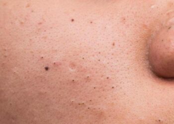 Mụn đầu đen khiến làn da trở nên sần sùi 