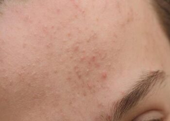 Mụn ẩn thường xuất hiện ở vùng trán