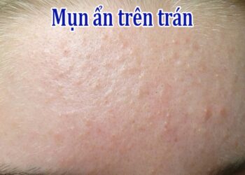7+ Cách trị mụn ẩn trên trán tại nhà hiệu quả, dễ làm nhất