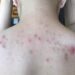 Biểu hiện lưng nổi mụn đỏ