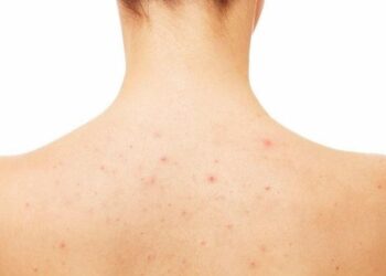 Mọc mụn nhọt ở lưng là bệnh gì? Cách điều trị hiệu quả