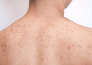 Nguyên nhân bị mụn lưng và 8 cách điều trị tại nhà hiệu quả