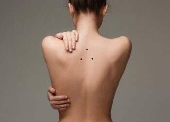 Nốt ruồi sau lưng nữ và nam có ý nghĩa gì? Có nên tẩy đi không?