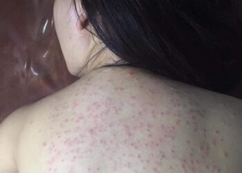 Cách trị viêm nang lông tại lưng nhanh hết