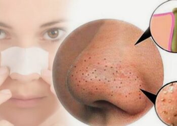 13 Sản Phẩm Trị Mụn Đầu Đen Tốt Nhất