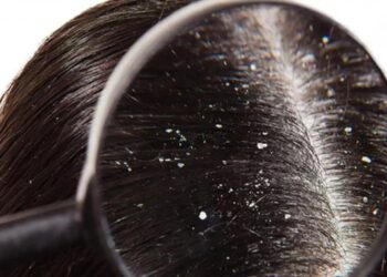 Tại sao đầu nhiều gầu?