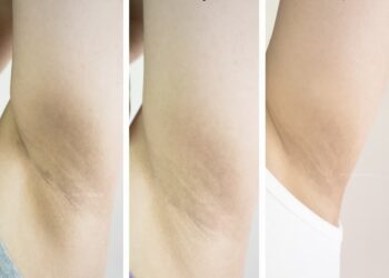 Thâm nách là gì?