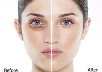 Trị thâm quầng mắt bằng khoai tây nguyên chất